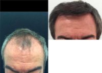 55-64 year old man treated with FUE Hair Transplant