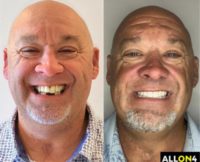 55-64 year old man treated with All-on-4 Dental Implants in Cancun