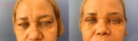 55-64 year old woman treated with Eyelid Surgery