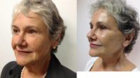 65-74 year old woman treated with Facelift