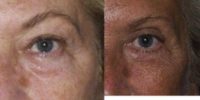 66y.o Upper and Lower Blepharoplasty