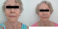 65-74 year old woman treated with Facelift