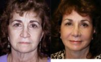 65-74 year old woman treated with Facelift, Rhinoplasty, Mini Neck Lift, Cheek Lift