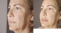 65-74 year old woman treated with Lip Fillers