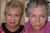 65-74 year old woman treated with Facelift