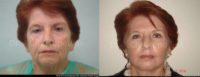 75 y.o. woman treated with Facelift + Blepharoplasty + Laser Skin Rejuvenation