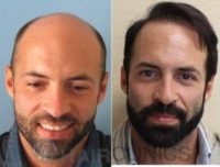 Before-after of FUE Hair Transplant