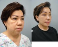 Facelift, Necklift, Rhinoplasty, Genioplasty, Browlift