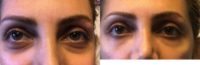 25-34 year old woman treated with Eye Bags Treatment