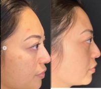 Woman treated with Facial