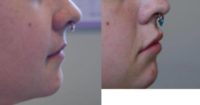 18-24 year old woman treated with Belotero Lip Fillers