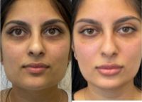 Woman treated with Dermal Fillers