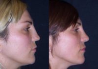 25-34 year old woman treated with Rhinoplasty