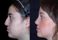 18-24 year old woman treated with Nose Surgery