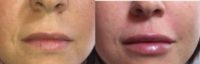 25-34 year old woman treated with Juvederm Ultra in the Lips