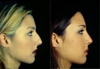 18-24 year old woman treated with Rhinoplasty