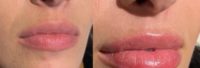 18-24 year old woman treated with Lip Fillers, Juvederm