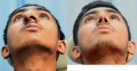 18-24 year old man treated with Rhinoplasty