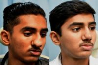 18-24 year old man treated with Rhinoplasty