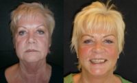 65 year old lady for Quicklift Face and Neck lift and Browlift