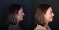 25-34 year old woman treated with Rhinoplasty