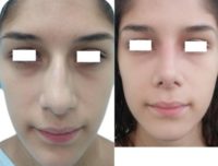 17 or under year old woman treated with Rhinoplasty