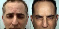 Botox Treatment for Forehead Wrinkles