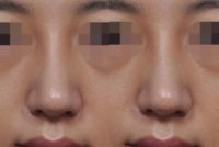 Hump nose treated with Rhinoplasty