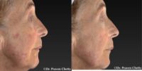 75 and up year old woman treated with Age Spots Treatment