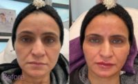 Woman treated with Lip Fillers