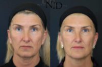 55-64 year old woman treated with Injectable Fillers