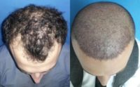 32 year old man Hair Transplant with Micro FUE 3600 Grafts- ELMAS Medical Center