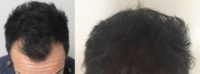 25-34 year old man treated with Hair Transplant