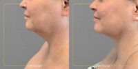 55-64 year old woman treated with AirSculpt