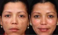 35-44 year old woman treated with Age Spots Treatment