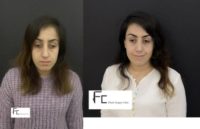 18-24 year old woman treated with Rhinoplasty