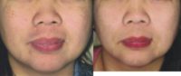 45 year old woman treated with Pico Laser for Pigmentation