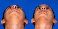 25-34 year old woman treated with Rhinoplasty