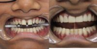 25-34 year old woman treated with Smile Makeover