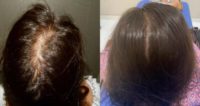 45-54 year old woman treated with Hair Transplant