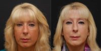 45-54 year old woman treated with Injectable Fillers for Tear trough rejuvenation