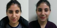 18-24 year old woman treated with Rhinoplasty