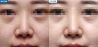 18-24 year old woman treated with Revision Rhinoplasty