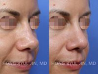 35-44 year old Caucasian woman treated with Revision Rhinoplasty