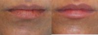 25-34 year old woman treated with Restylane SILK