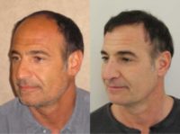 45-54 year old man treated with Hair Transplant