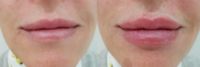 35-44 year old woman treated with Lip Augmentation