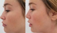 25-34 year old woman treated with Nonsurgical Nose Job