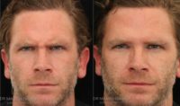Male Botox To Reduce Frown Lines