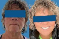 45-54 year old woman treated with Facelift